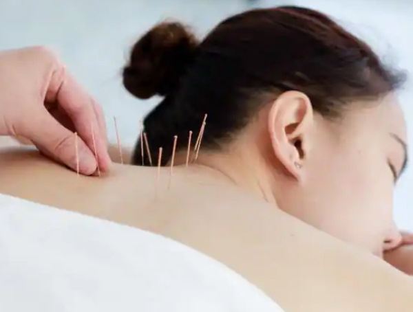 Acupuncture
